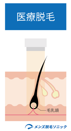 医療脱毛のイメージ図