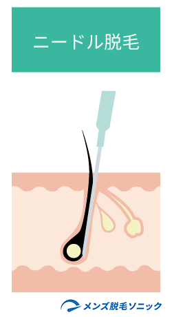 ニードル脱毛のイメージ図