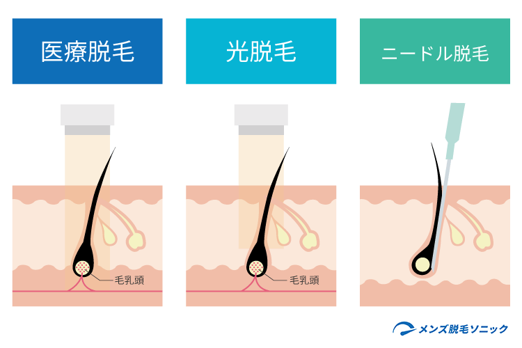 ヒゲ脱毛の種類